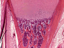 二水焦磷酸钙结晶沉积症的图片