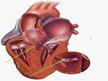 肥厚型梗阻性心肌病的图片