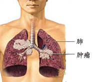 肺癌的图片