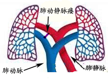 肺动静脉瘤的图片