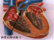 肺动脉口狭窄的图片
