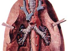 肺结核的图片