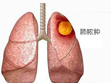 肺脓肿的图片