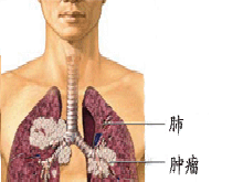 肺转移瘤的图片