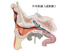 分泌性中耳炎的图片