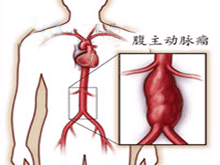 腹主动脉血栓形成综合征的图片