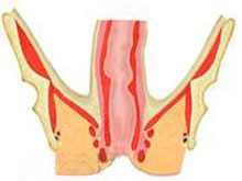 骨盆直肠脓肿的图片