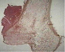 骨肉瘤的图片
