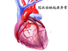 冠状动脉异位起源的图片