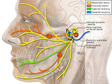 颌面部神经纤维瘤的图片