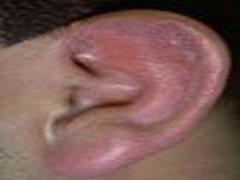 化脓性耳廓软骨膜炎的图片
