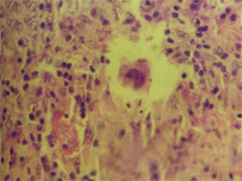 霍奇金淋巴瘤的图片