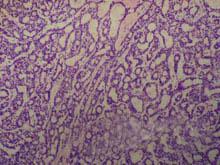 基底细胞腺瘤的图片