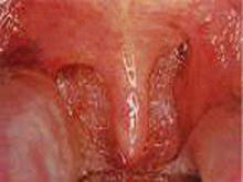 急性单纯性咽炎的图片