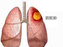 急性肺脓肿的图片