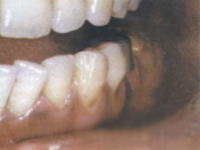 急性颌骨骨髓炎的图片