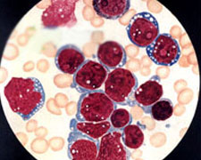 急性淋巴细胞性白血病的图片