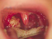 急性舌扁桃体炎的图片