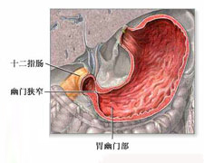 急性胃肠炎的图片
