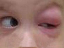 急性眼眶蜂窝织炎的图片