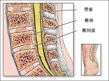 脊髓肿瘤的图片