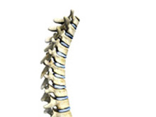 脊椎骨骨髓炎的图片