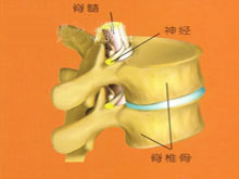 脊椎结核的图片