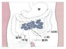假膜性肠炎的图片