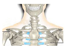 颈肋综合征的图片