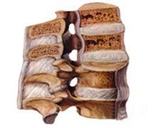 颈椎管狭窄症的图片