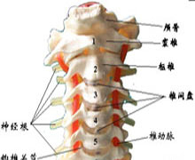 颈椎双侧关节突关节脱位的图片