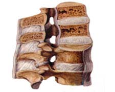 颈椎小关节创伤性退变性关节炎的图片